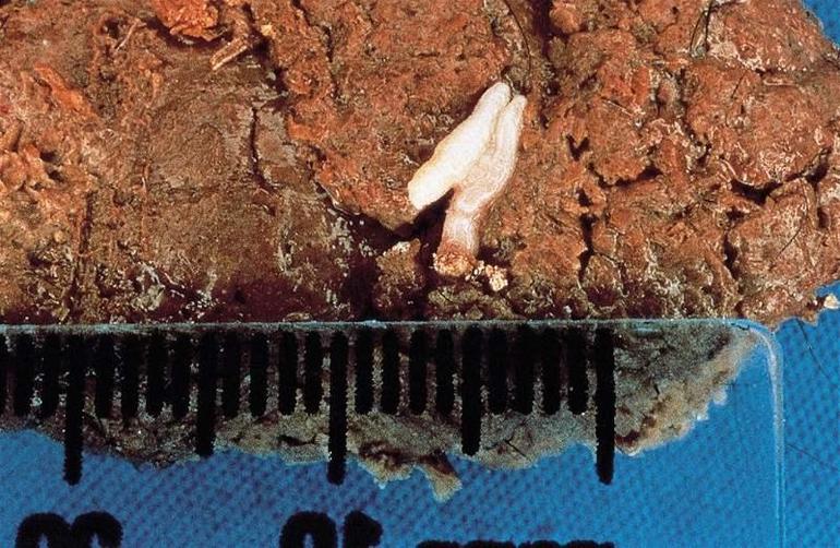 Si des taches blanches se trouvent dans les matières fécales